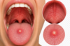 roof of mouth pain