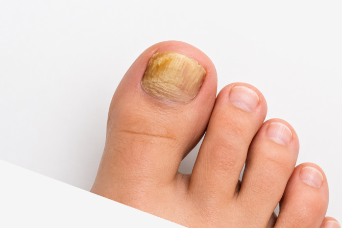 treatment nail fungus