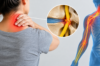 What Is a Pinched Nerve