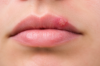 cold sore on lips home remedies