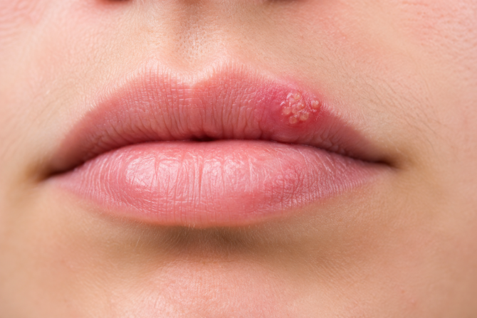 cold sore on lips home remedies