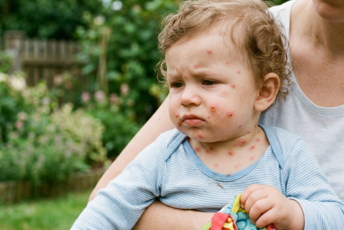 Chickenpox