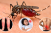 Symptoms of Chikungunya