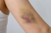 bruise on body