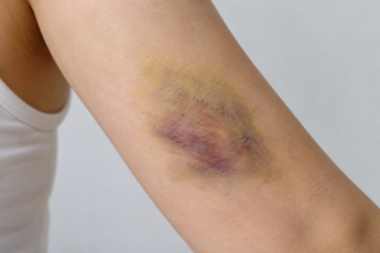 bruise on body
