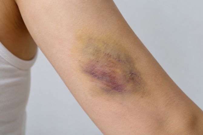 bruise on body