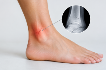 hairline fracture