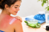 how to treat sunburn
