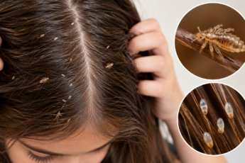 lice and nits home remedies