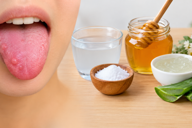 tongue bumps remedies