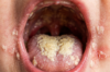 Infant Oral Thrush