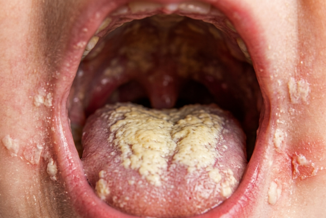 Infant Oral Thrush