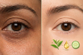 Remedies for Dark Circles
