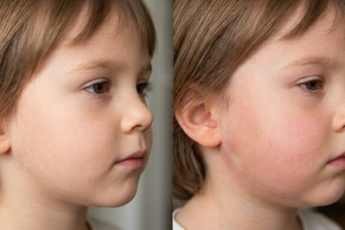Mumps Symptoms